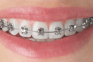 tratamento com aparelho autoligado nos dentes