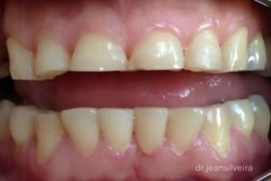 bruxismo desgaste dos dentes causado pelo ranger dental