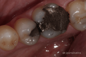 troca de amálgama por resina vale a pena para evitar fratura dentária