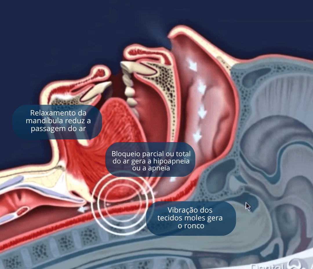 como-acontece-o-ronco-apneia